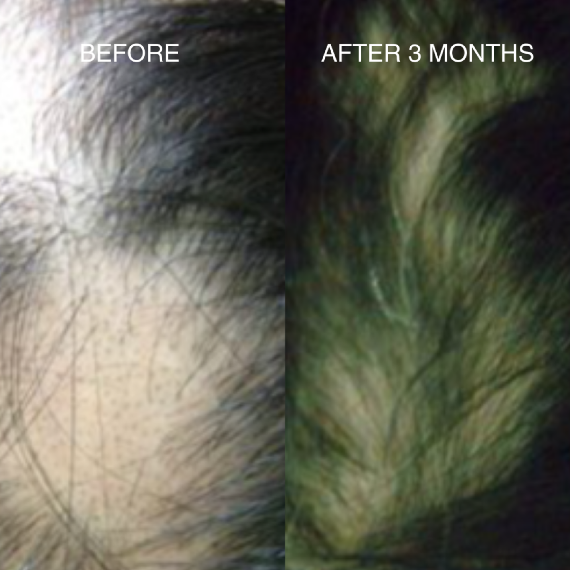 DRGL-DrHair Hair loss Transformation Package-05