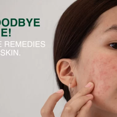 What is Melasma?